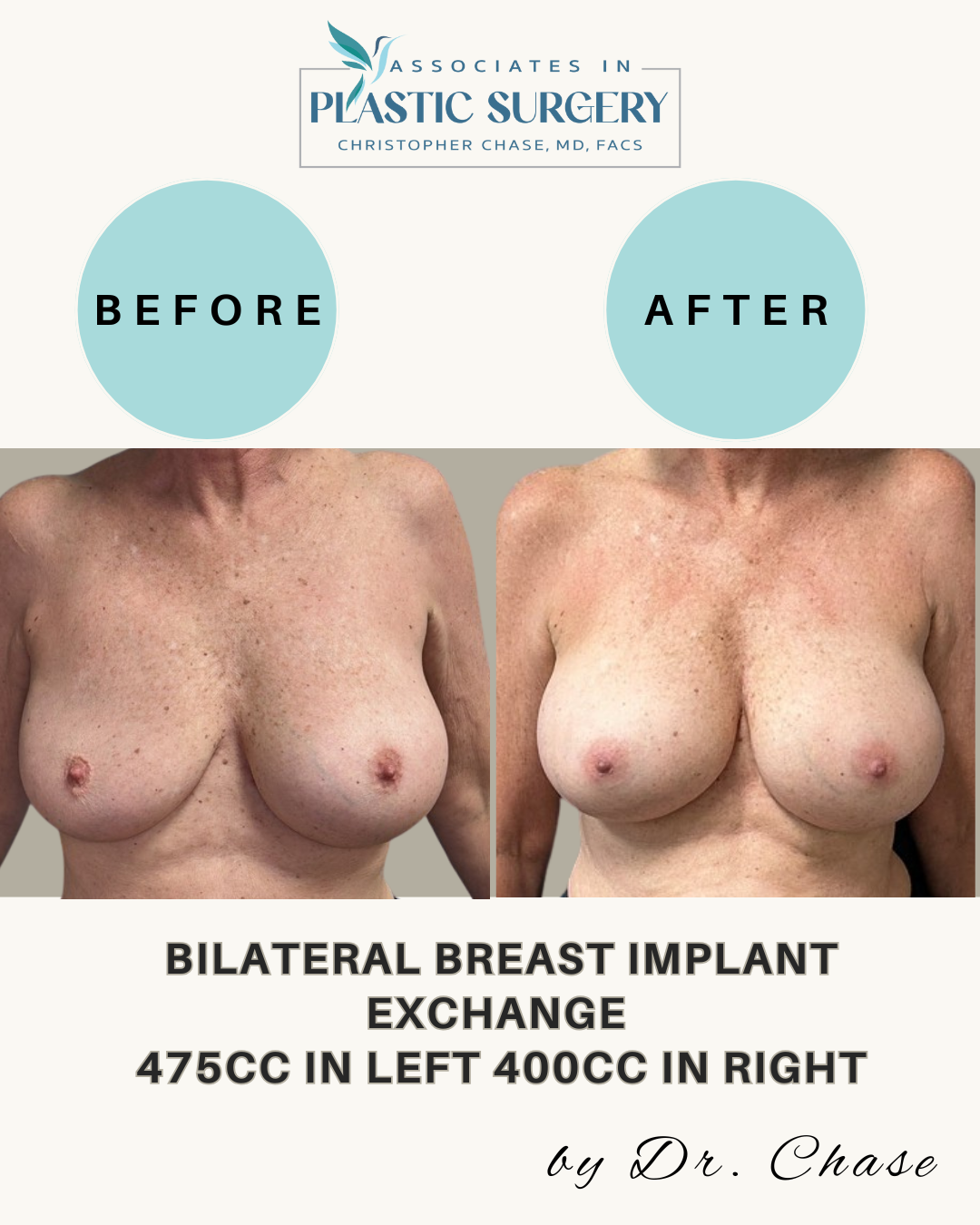 Before-and-after of breast implant exchange. Breasts appear fuller. Shows change in size and shape after surgery.
