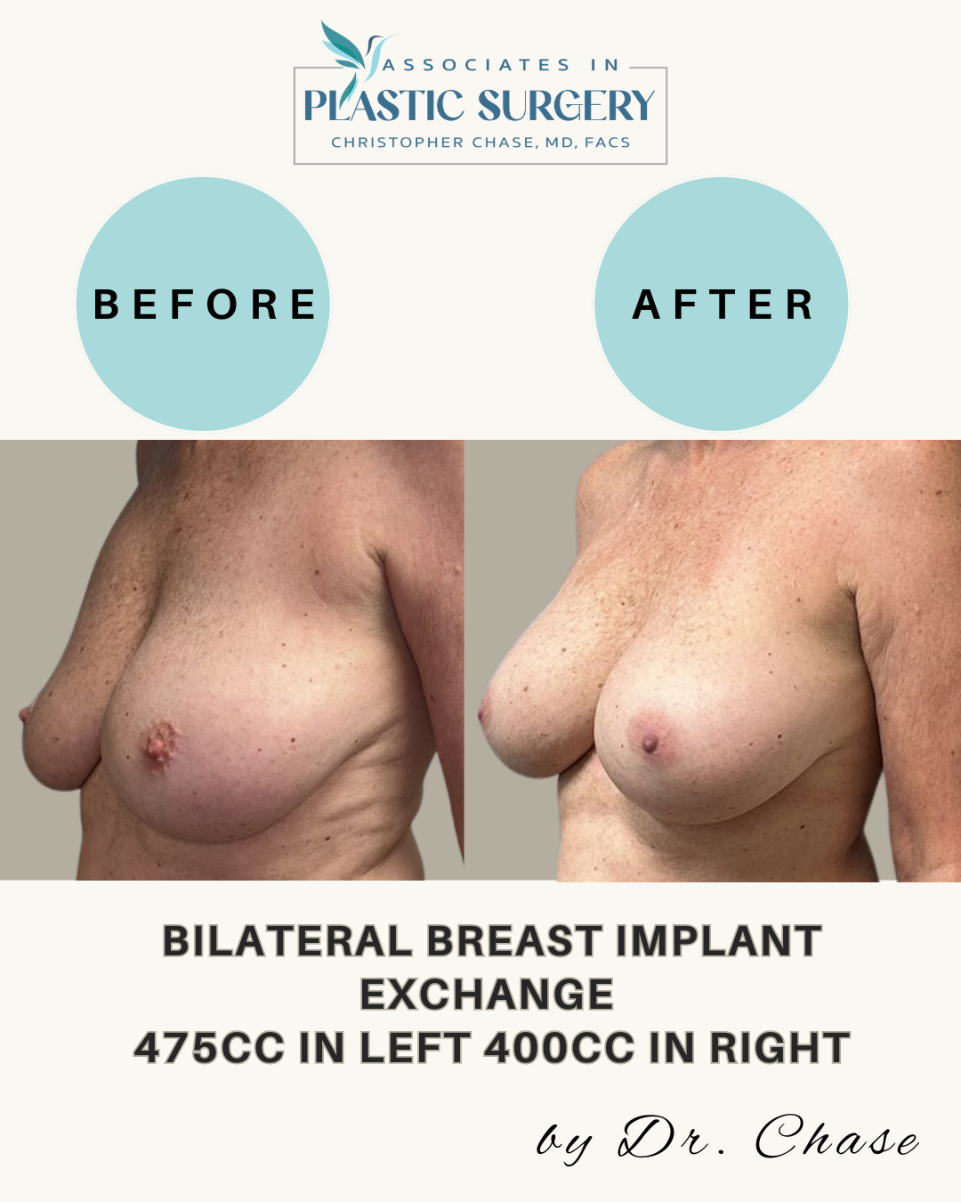 Before and after breast implant exchange, showing increased breast size.