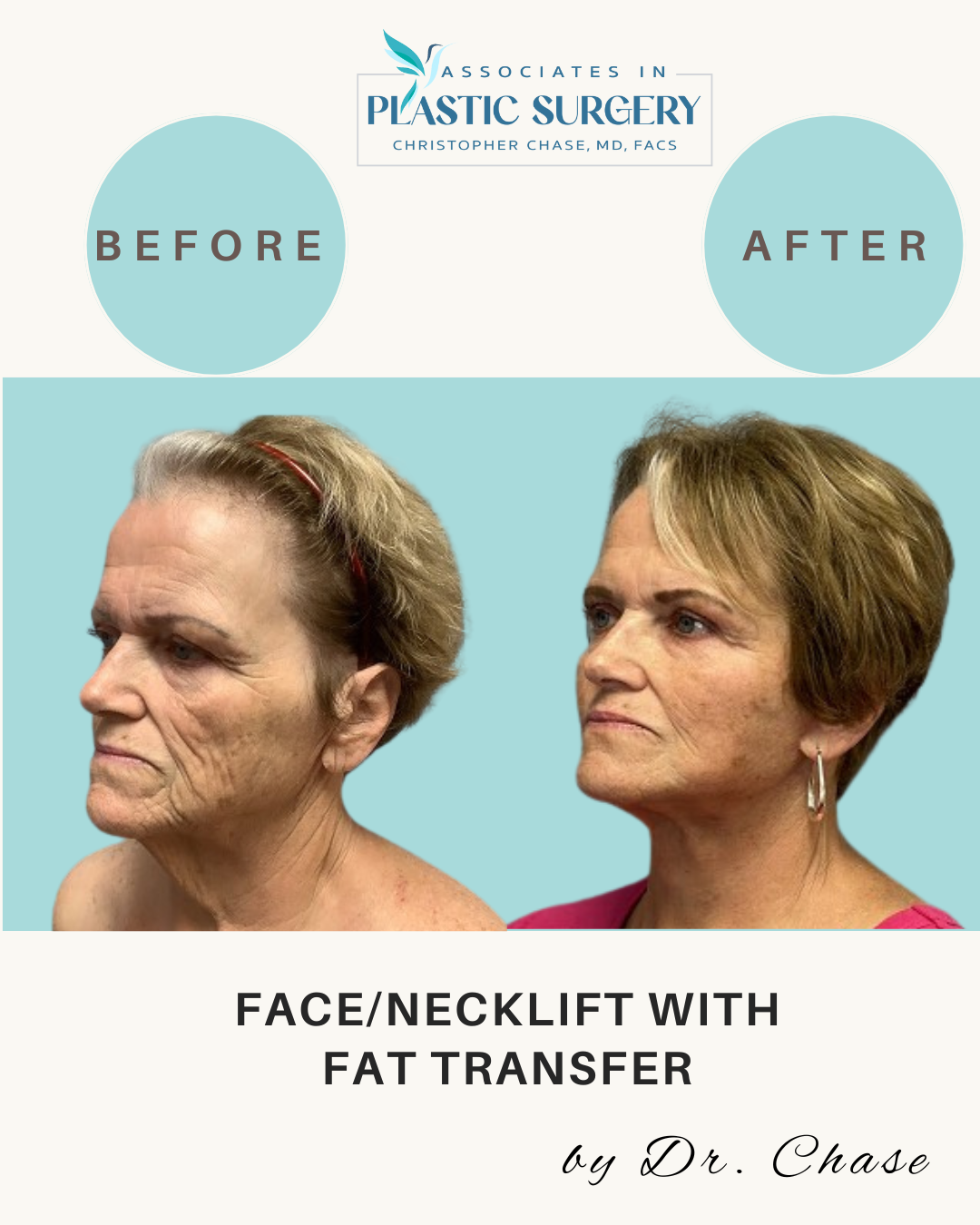 Side-by-side comparison of a person before and after a face/necklift with fat transfer.