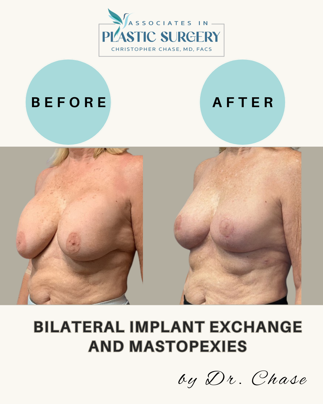 Before/after photos of breasts.  Bilateral implant exchange and mastopexies surgery. Light blue color scheme.