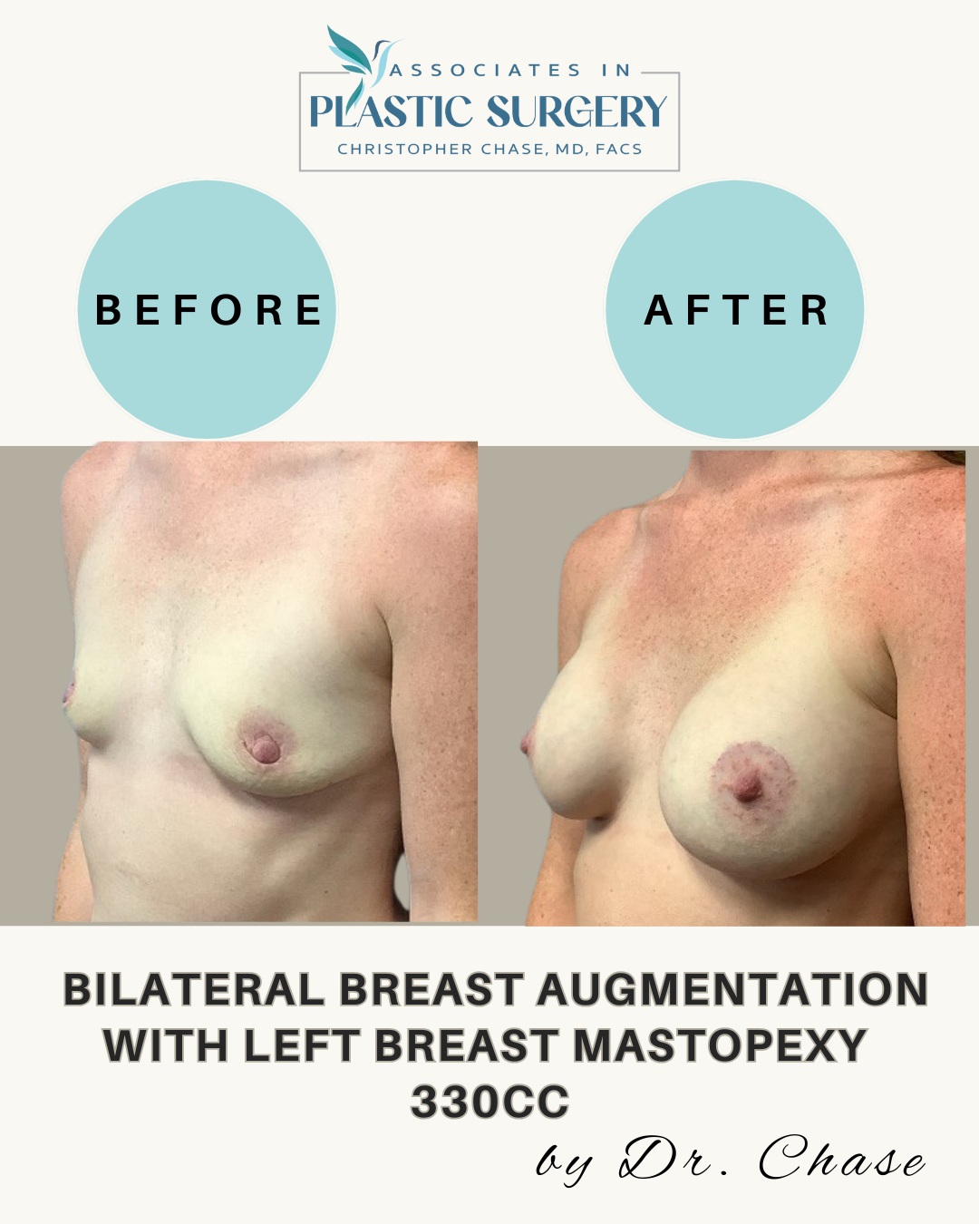 Breast augmentation before and after.  Text reads 