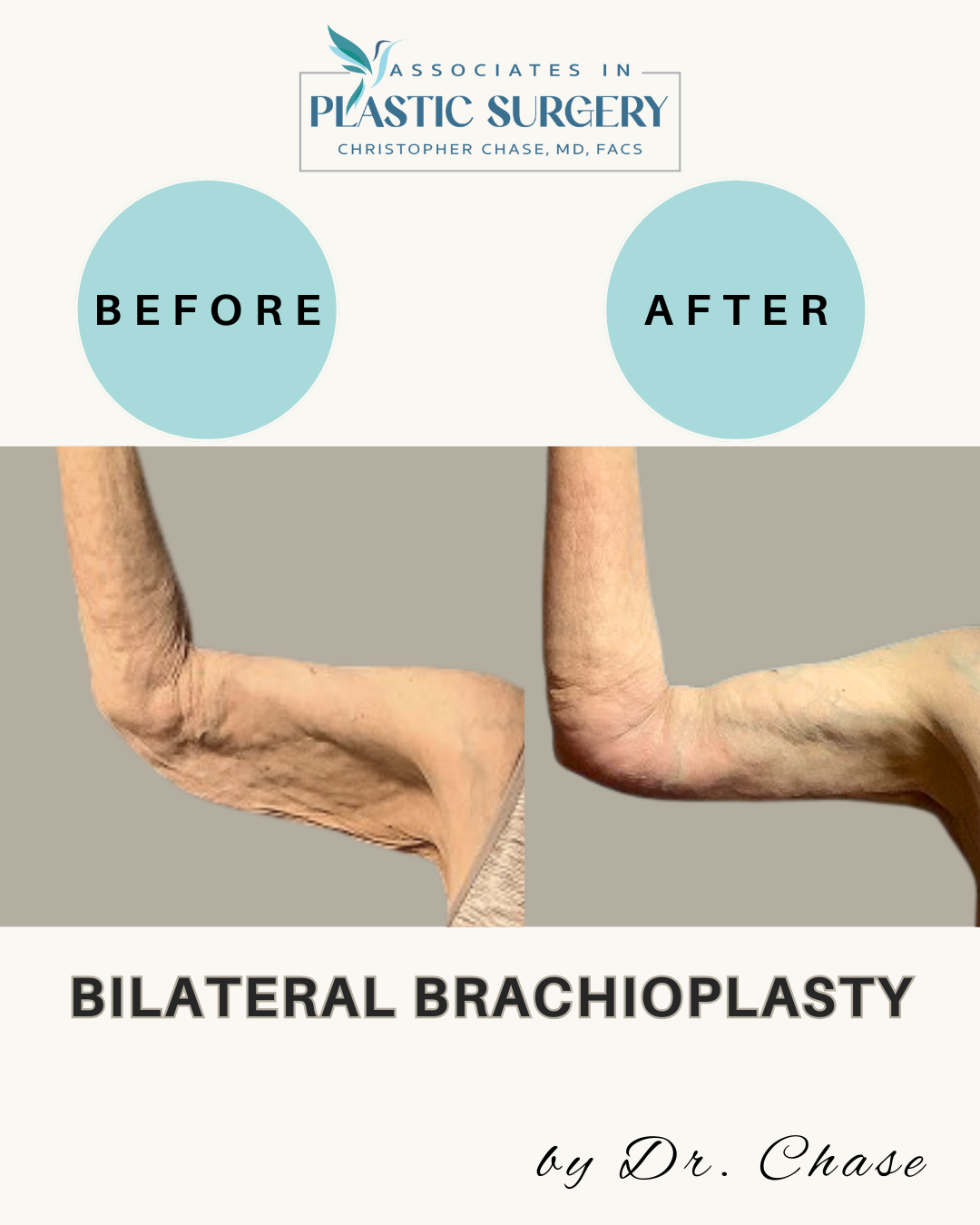 Comparison of arms before and after bilateral brachioplasty; light blue circles label the 