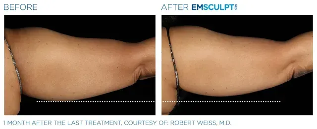 Associates in Plastic Surgery Emsculpt Procedure