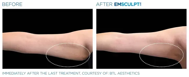 Associates in Plastic Surgery Emsculpt Procedure