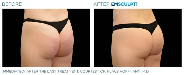 Associates in Plastic Surgery Emsculpt Procedure