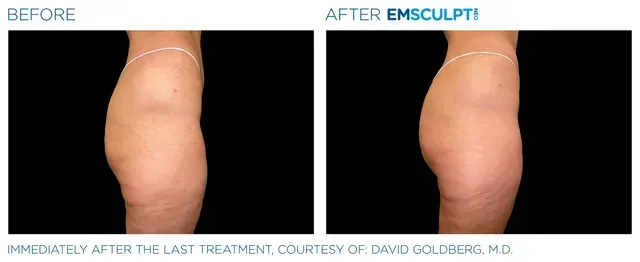 Associates in Plastic Surgery Emsculpt Procedure