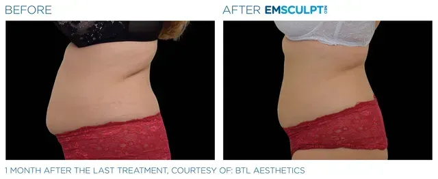 Associates in Plastic Surgery Emsculpt Procedure