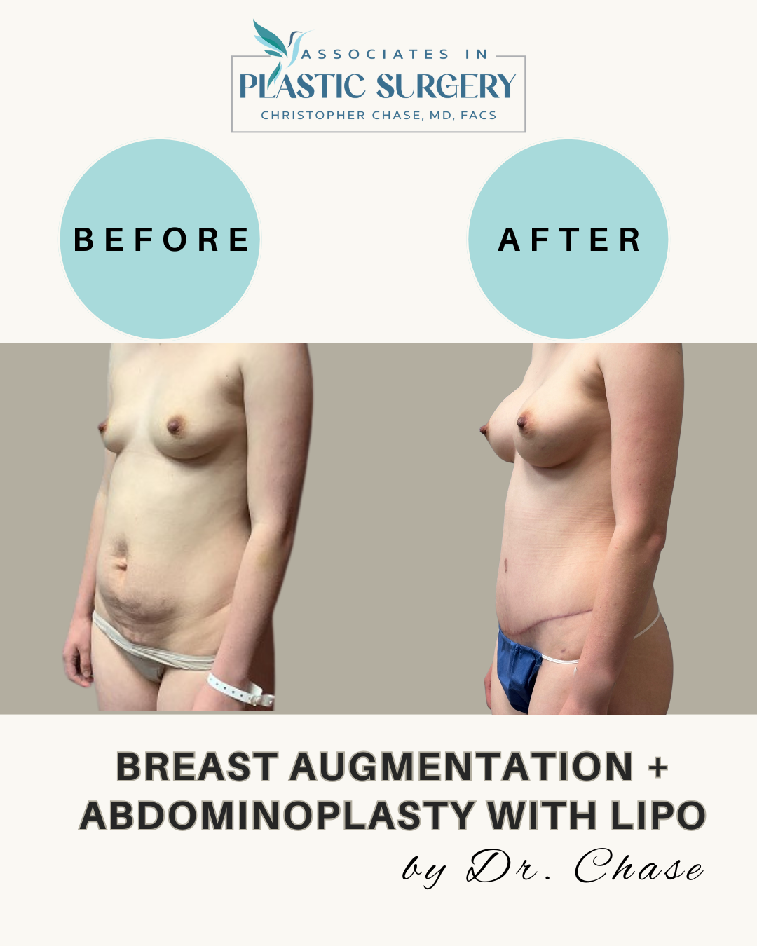 Side-by-side photos: before and after breast augmentation and abdominoplasty with lipo. Woman's torso; light skin.