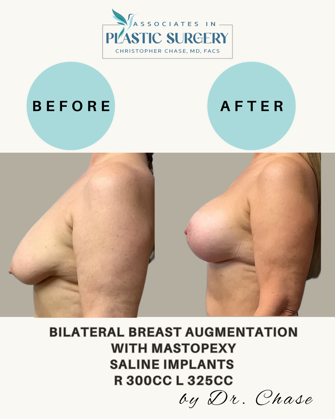 Before and after of breast augmentation. Shows breast lift and saline implants.