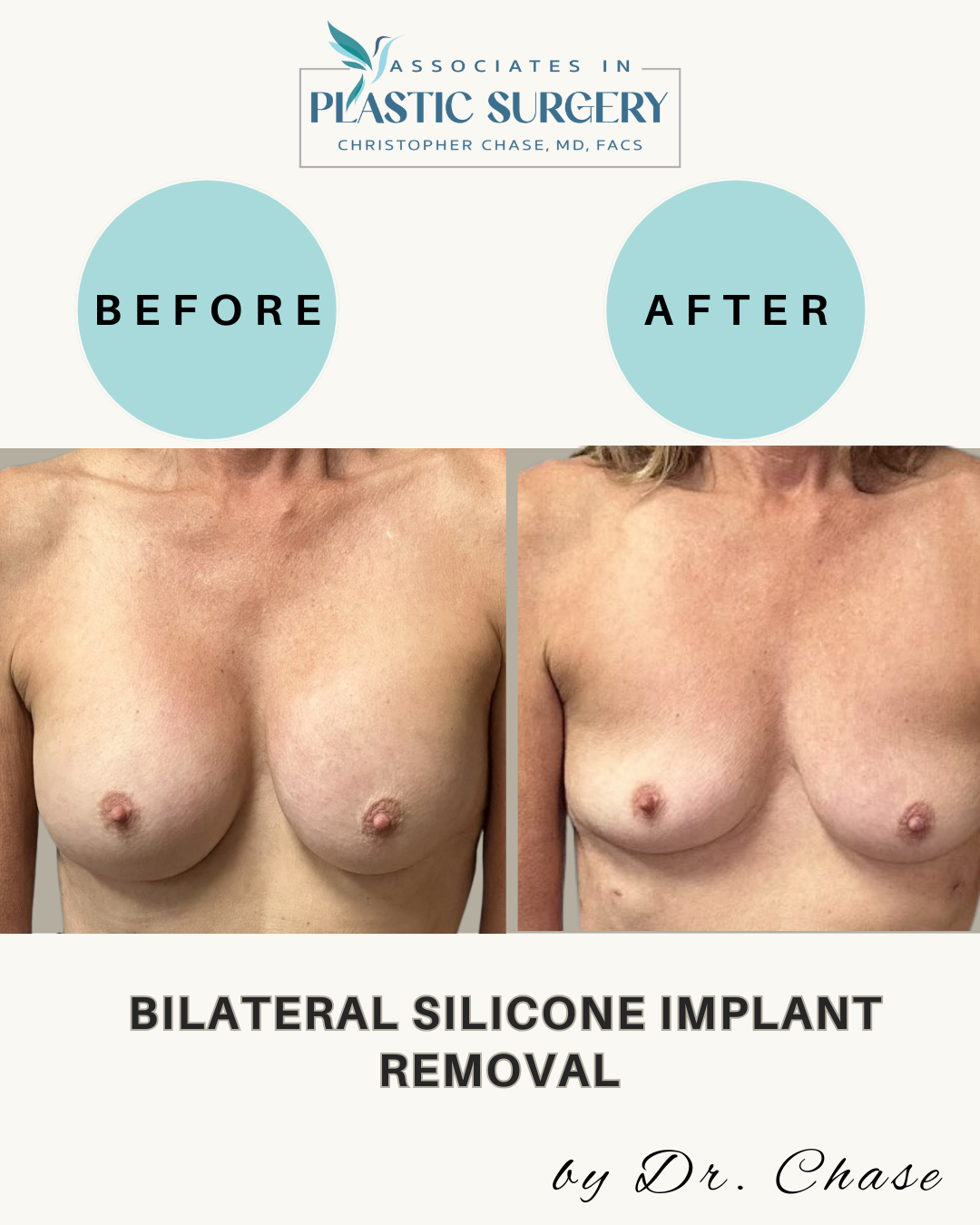 Before and after photos showing breast appearance change after silicone implant removal.