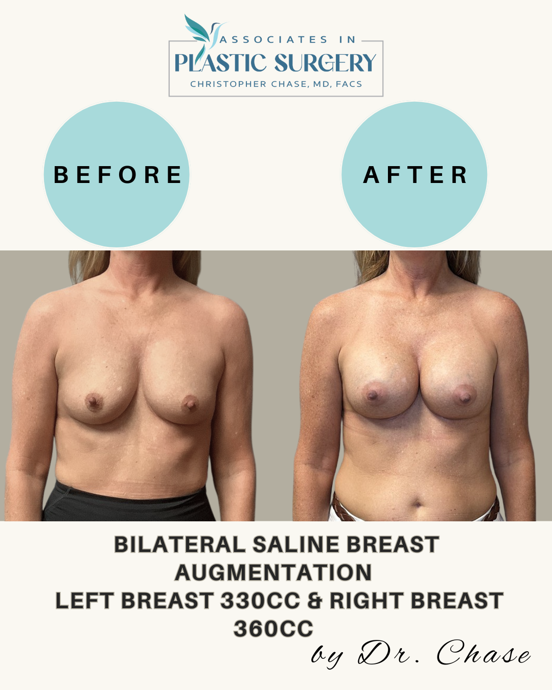 Before and after comparison of a woman's breast augmentation.