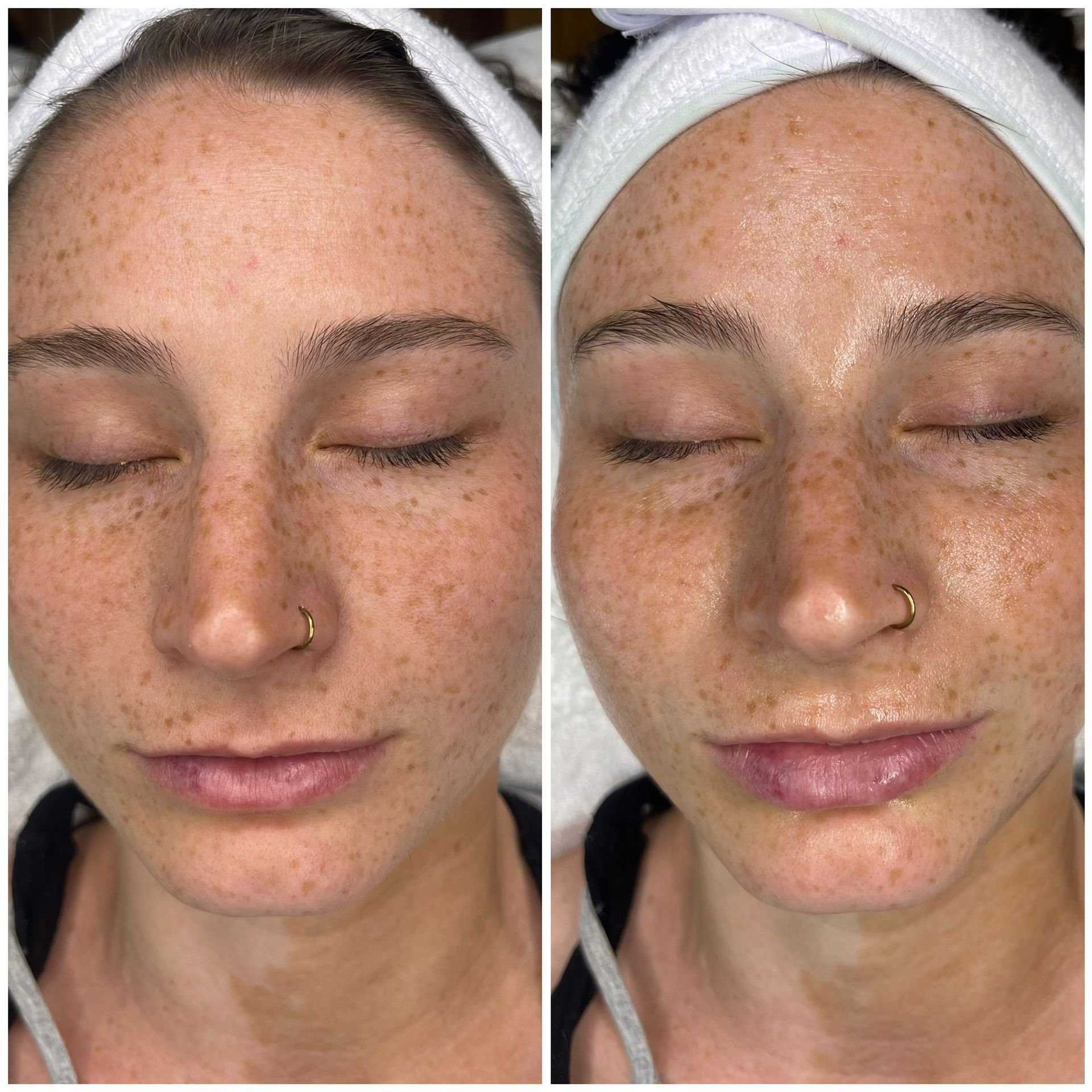 Two side-by-side portraits of a person with freckles, wearing a white towel. Right image has visible sheen.