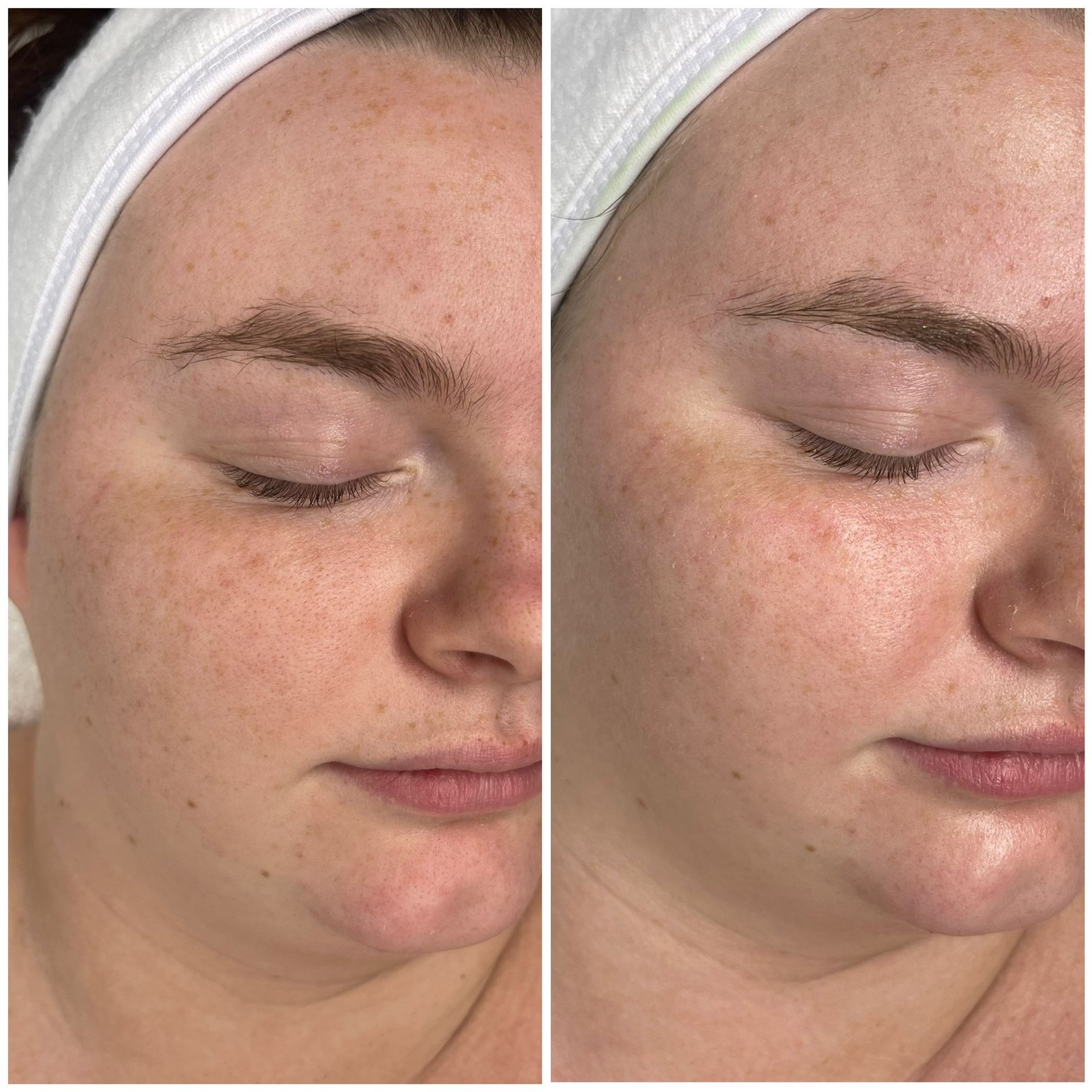 Side-by-side comparison of a person's face. Left side: skin with freckles. Right side: skin appears clearer.
