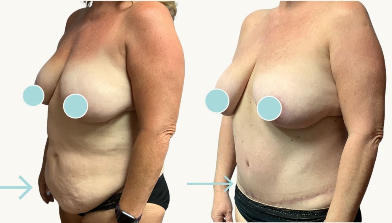 Before and after torso views. Woman's torso shows possible skin removal and breast lift surgery results.