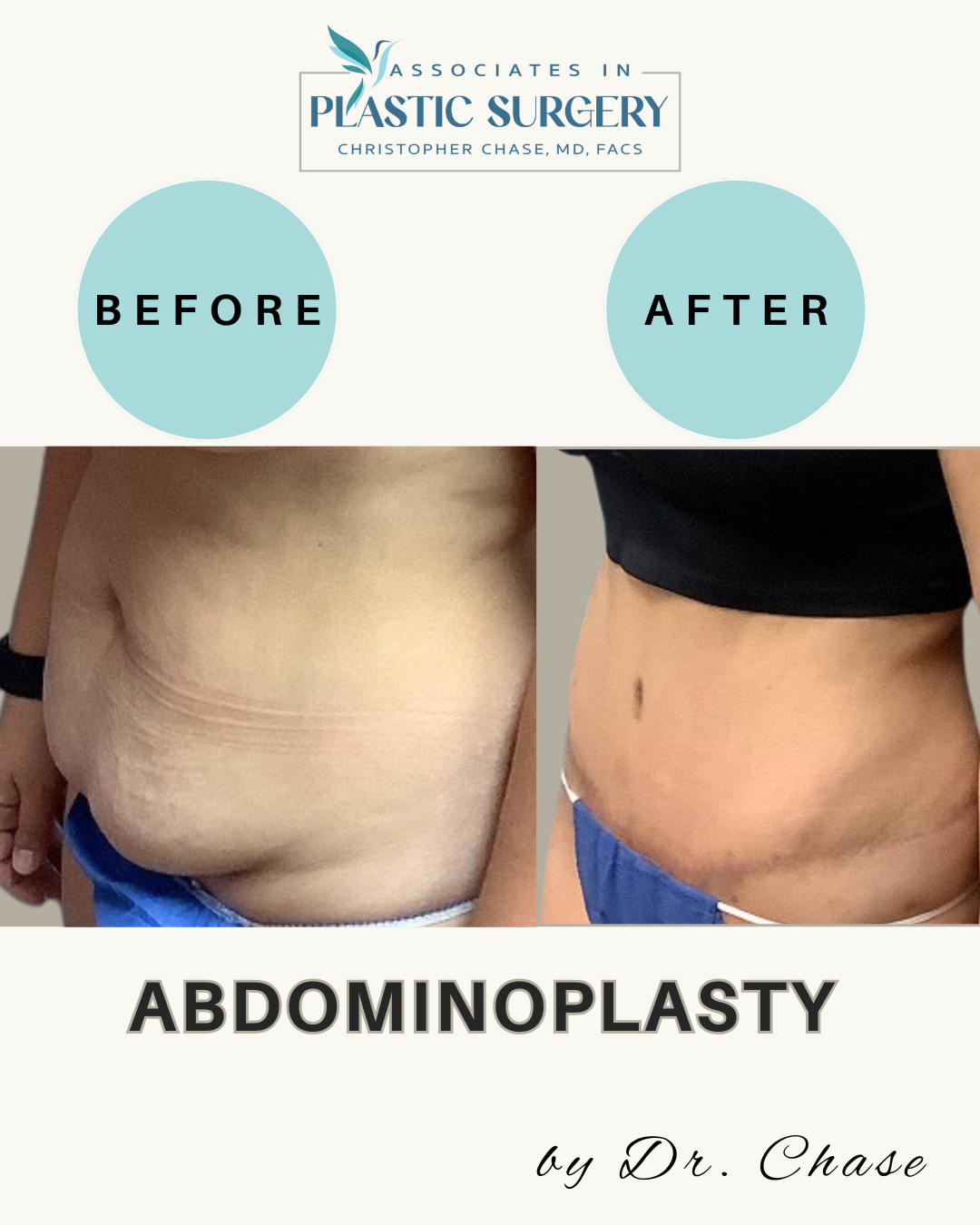 Abdominoplasty before and after photos. The 