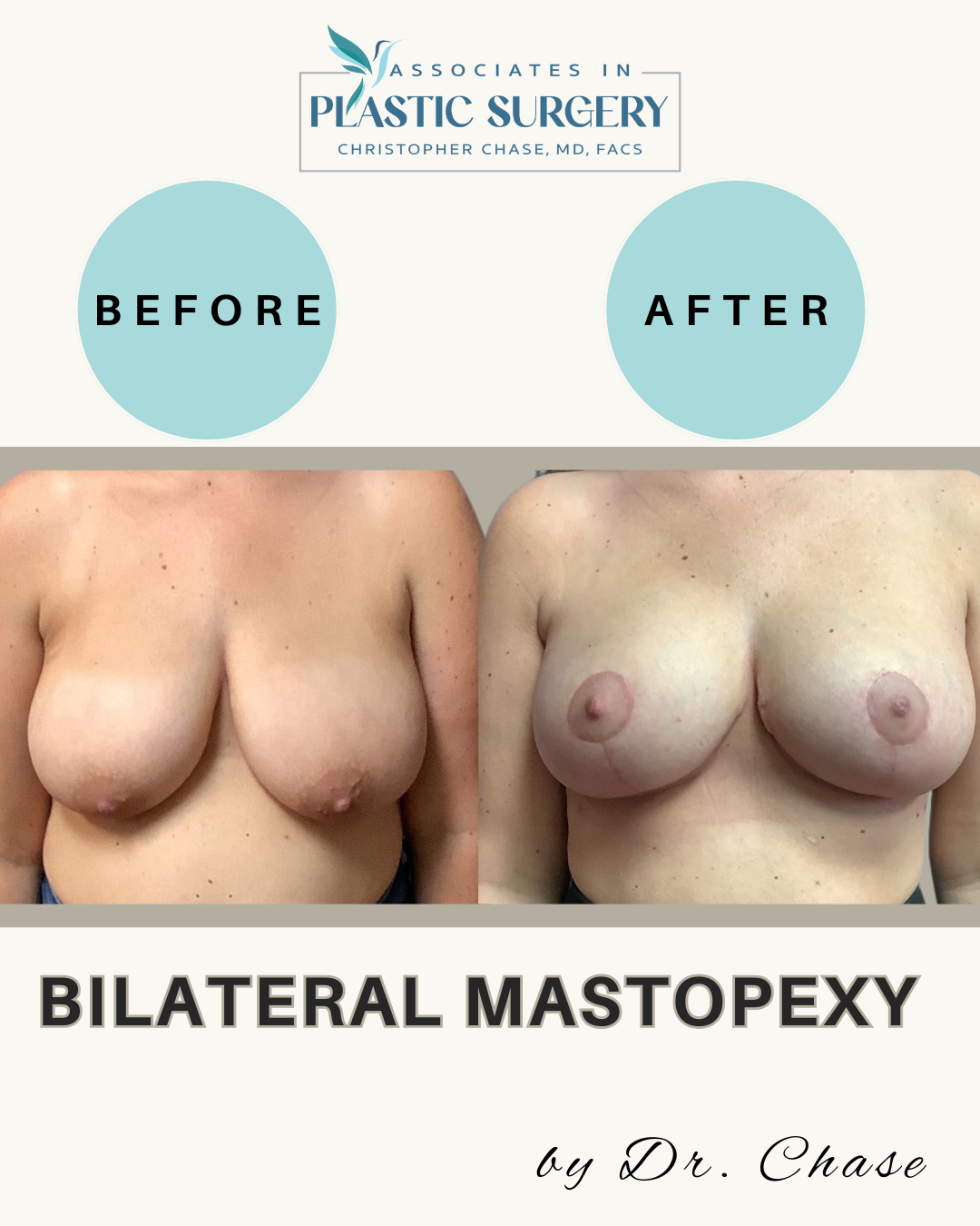 Before and after comparison of breasts after bilateral mastopexy.