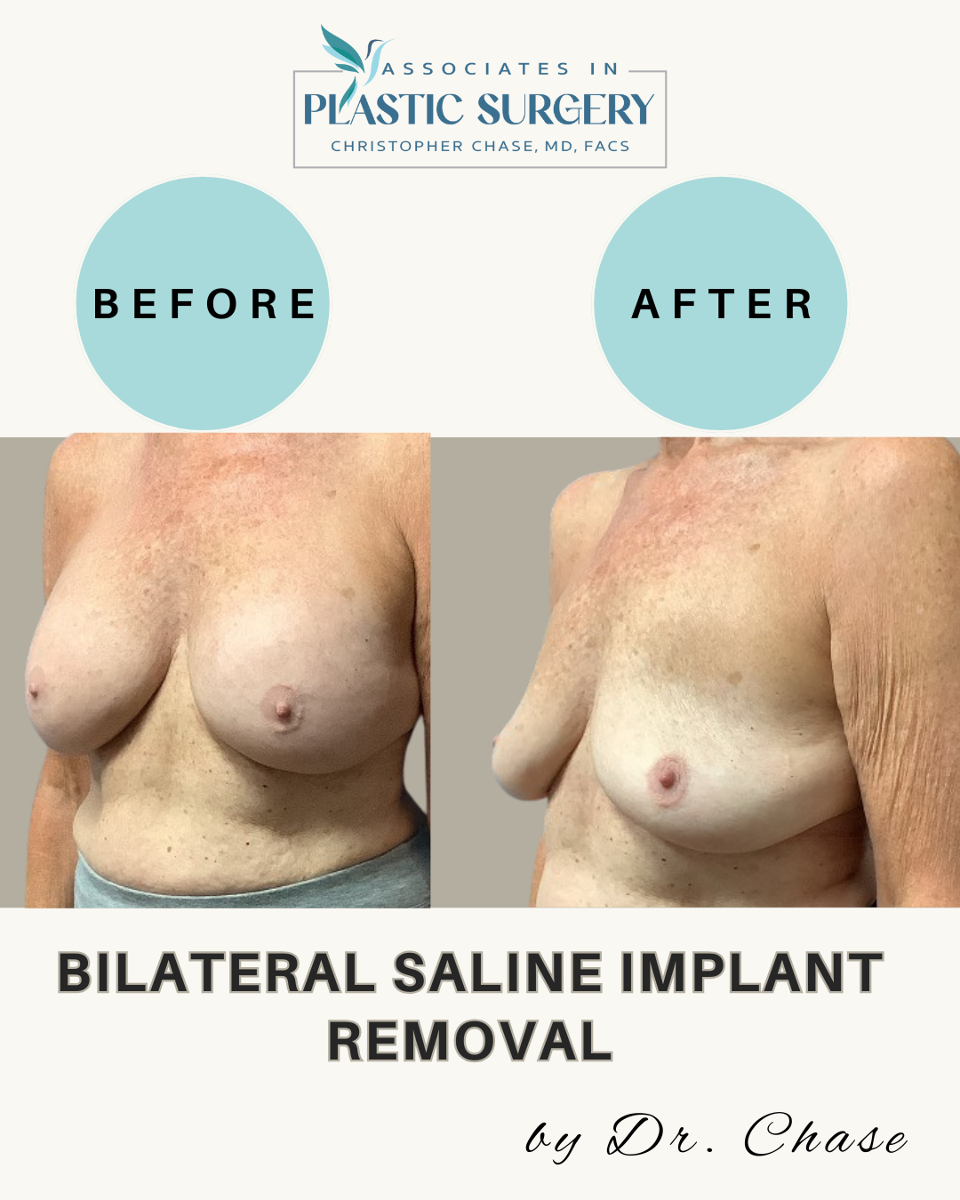 Before and after photos of saline implant removal, showing breast appearance change.