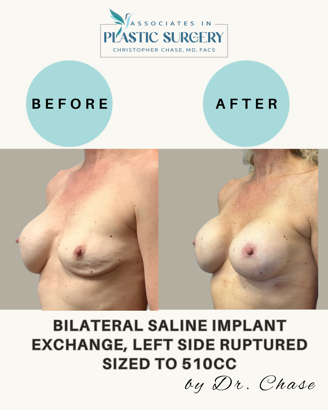 Before and after comparison of breast implants. Bilateral saline implant exchange sized to 510cc.