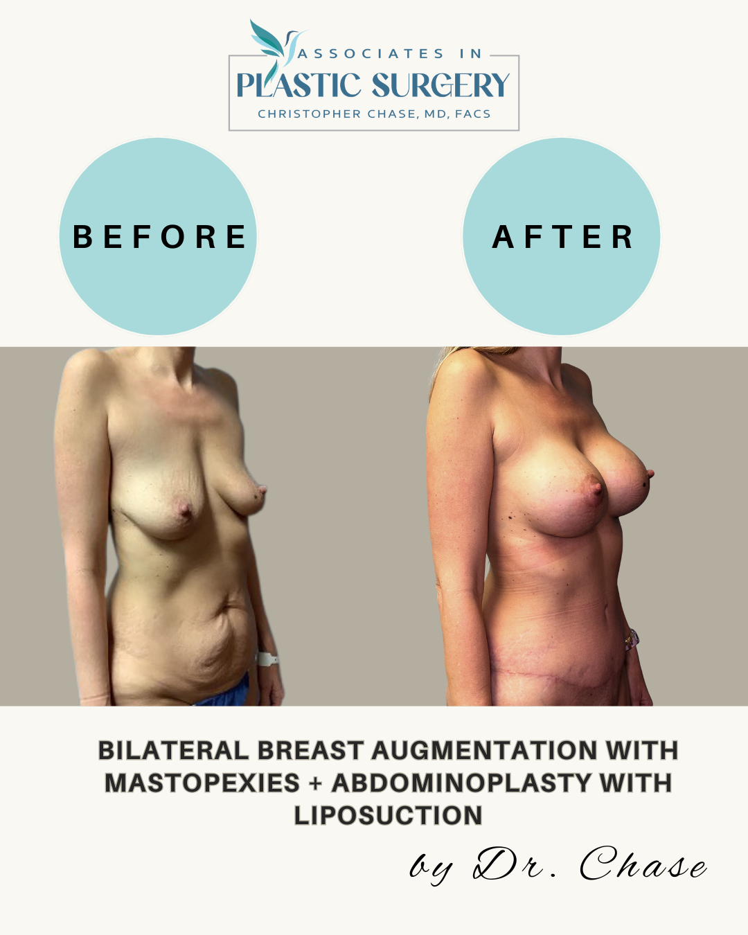 Before-and-after of breast augmentation, mastopexy, abdominoplasty, and liposuction.