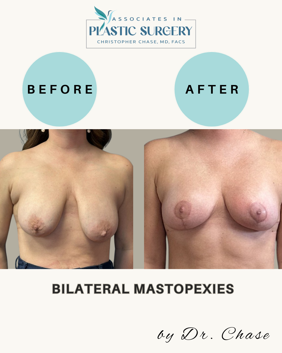 Before-and-after of breasts after bilateral mastopexies. Shows the surgical outcome.