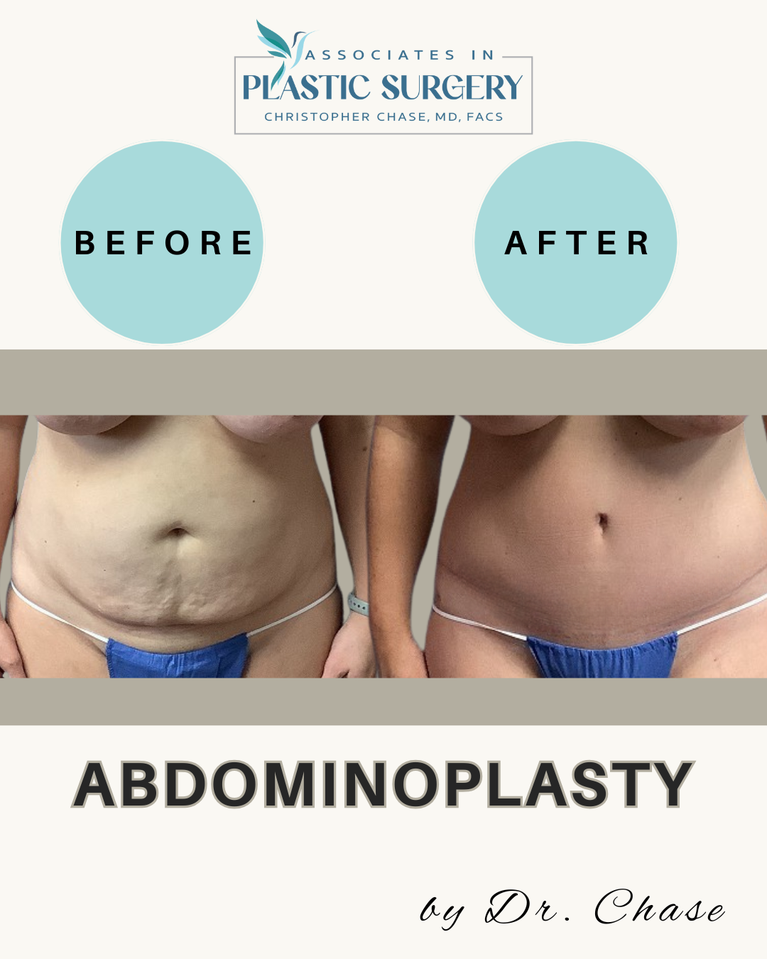 Before and after photos showing an abdominoplasty procedure.