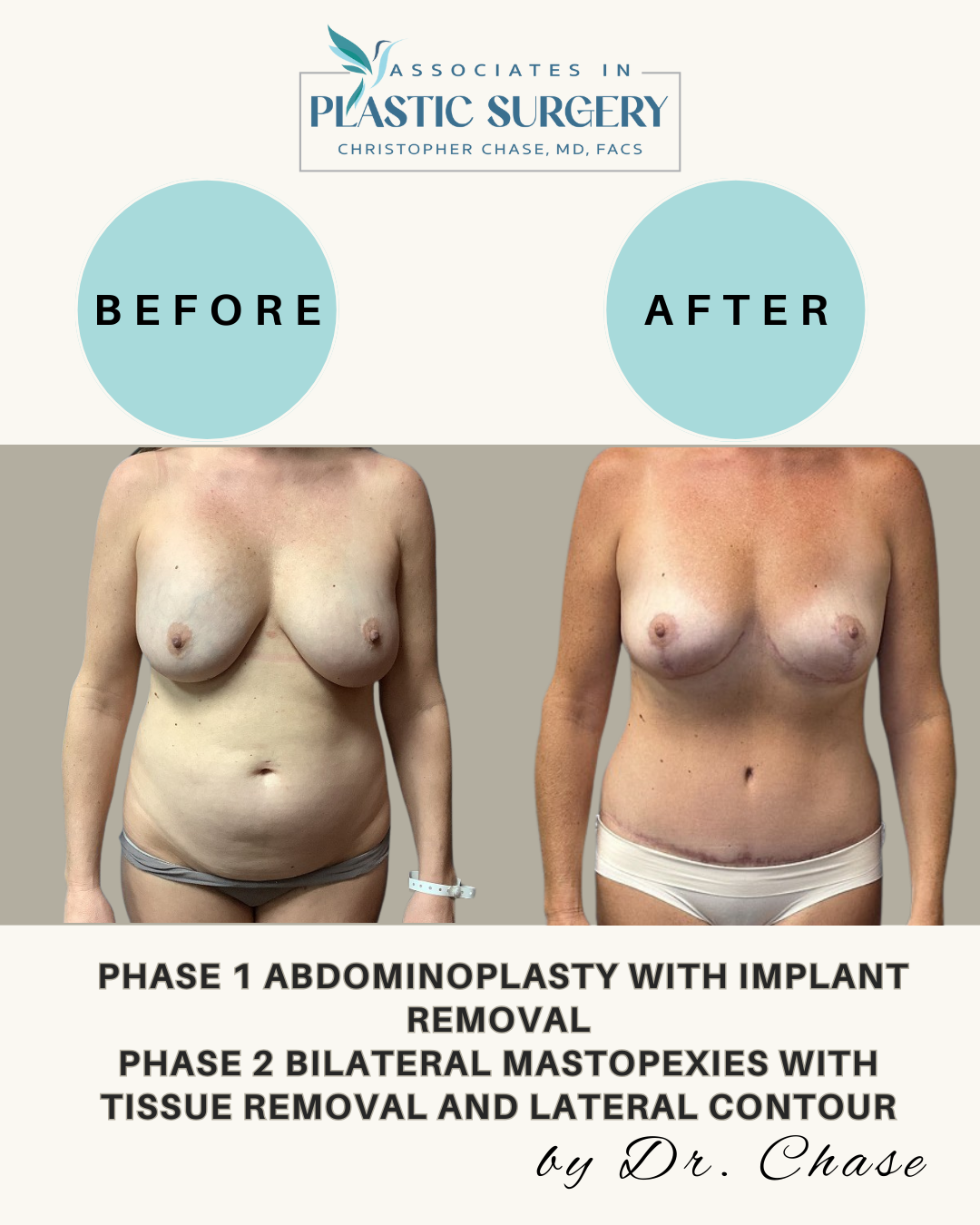 Before and after photos showing abdominoplasty and mastopexy results.