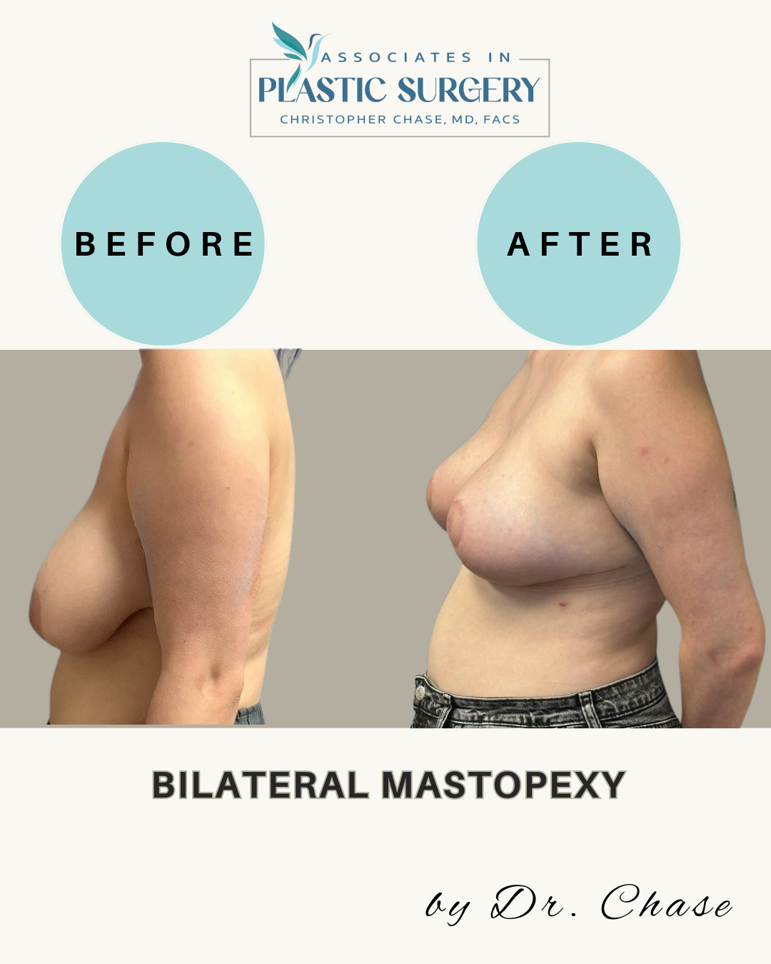 Before and after images of a bilateral mastopexy. The after image shows larger breasts.