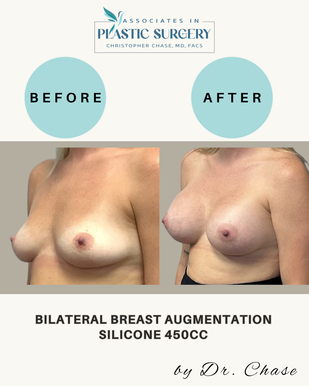 Before and after breasts; augmentation with 450cc silicone implants.
