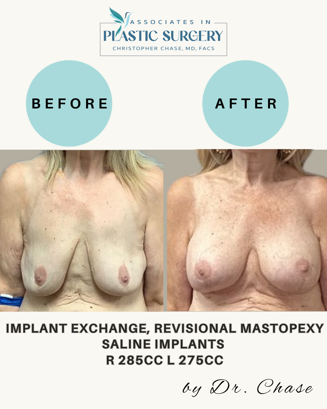 Before and after photos of breast augmentation with saline implants performed by Dr. Chase.