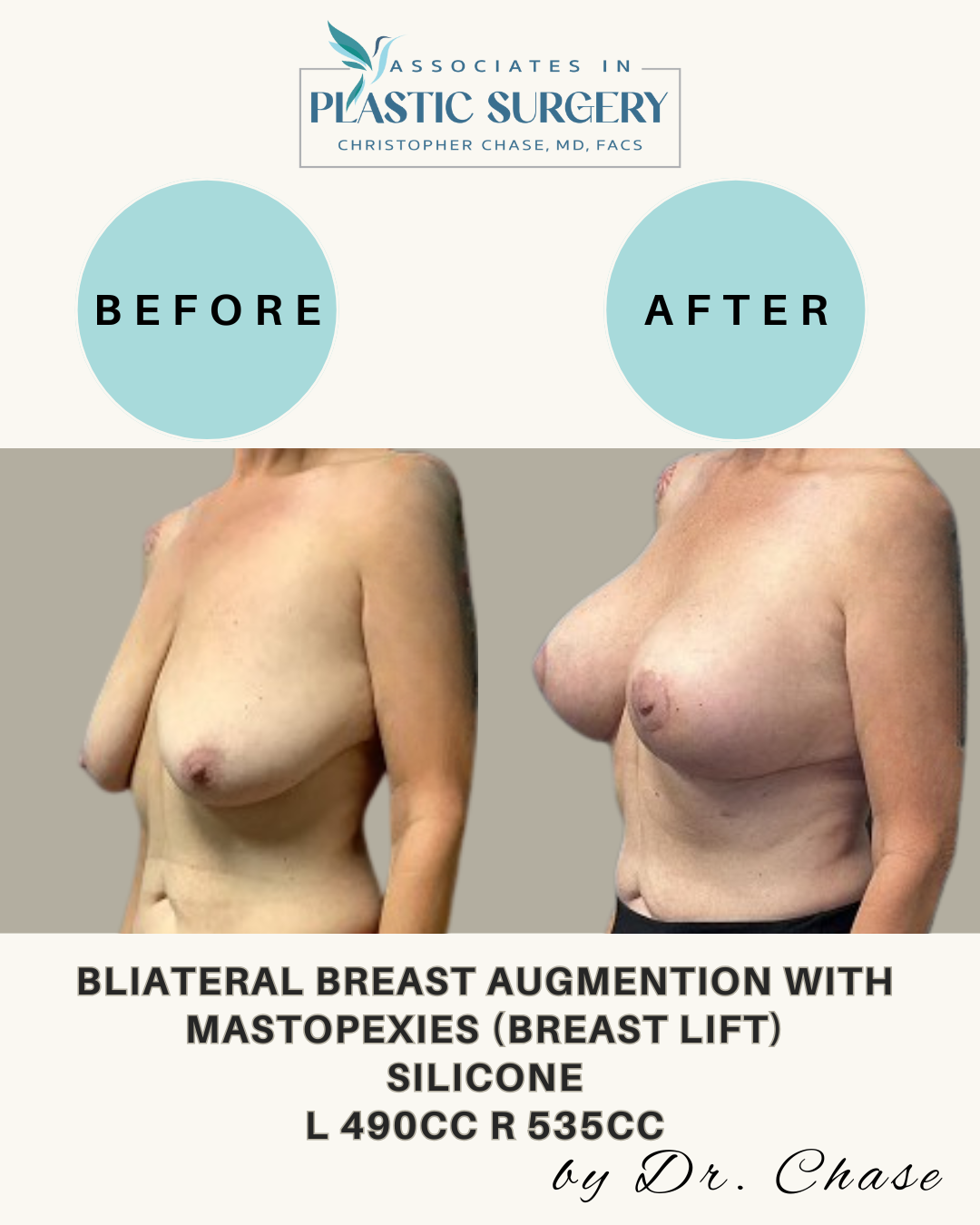 Before and after breast augmentation.  Left breast: 490cc silicone. Right breast: 535cc silicone.