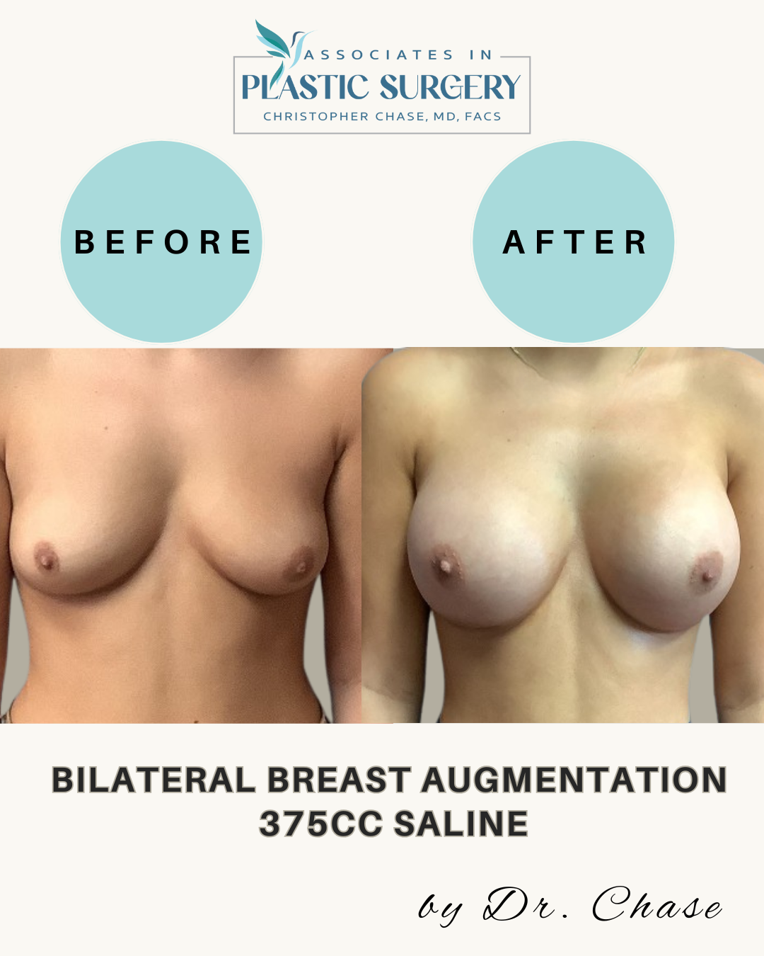 Before and after breasts comparison. Breasts are fuller after 375cc saline augmentation.