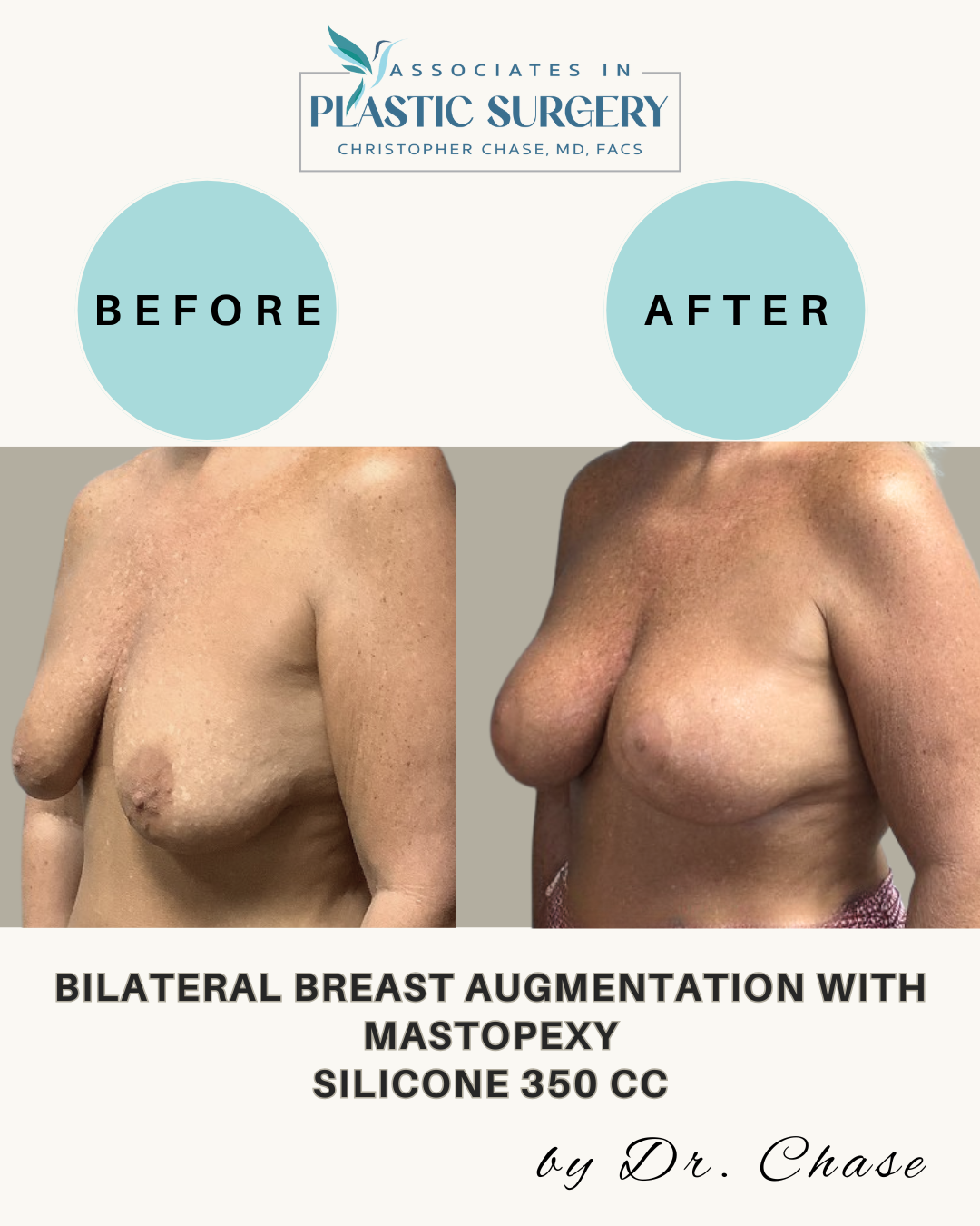 Side-by-side view showing before and after results of a breast augmentation with mastopexy.