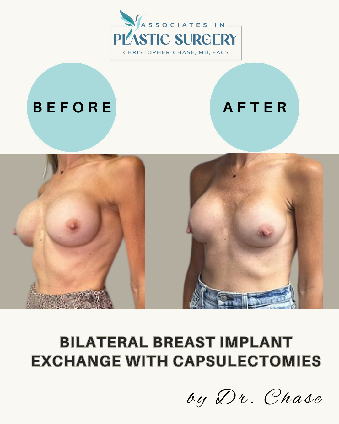 Bilateral Breast Implant Exchange with Capsulectomies by Dr. Chase before and after photos.