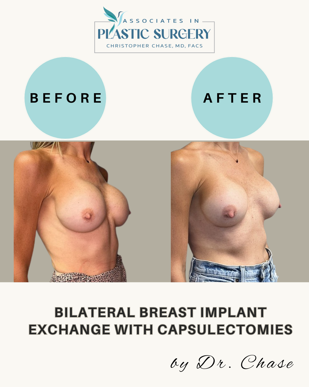 Breast augmentation before and after photos. The after photo shows a lifted appearance.