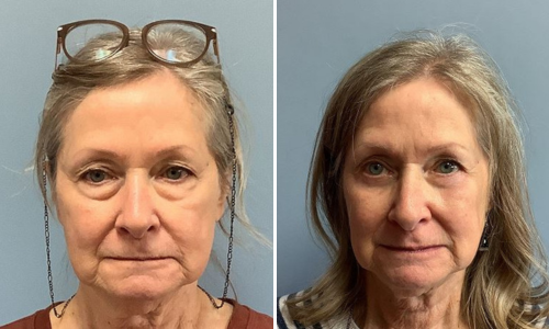 Associates in Plastic Surgery Brow Lift