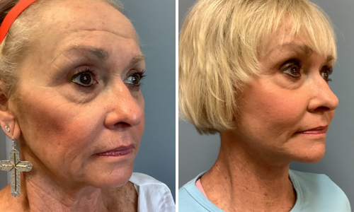 Associates in Plastic Surgery Brow Lift