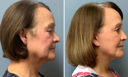 Associates in Plastic Surgery Brow Lift