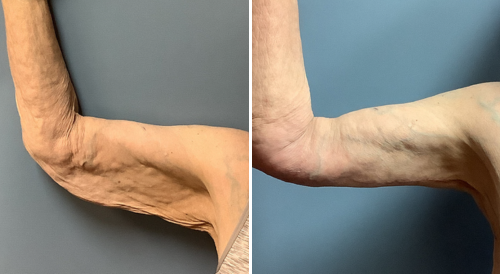 Arm lift before and after. Flabby arm on the left, firmer arm on the right, against a gray background.