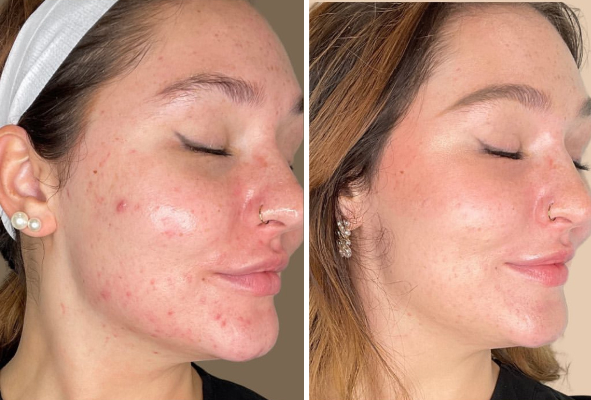 Side-by-side photos of a person with facial acne and a photo with reduced acne, showing skin improvement.