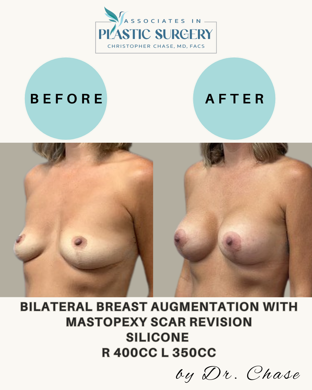 Before and after breast augmentation.  The 