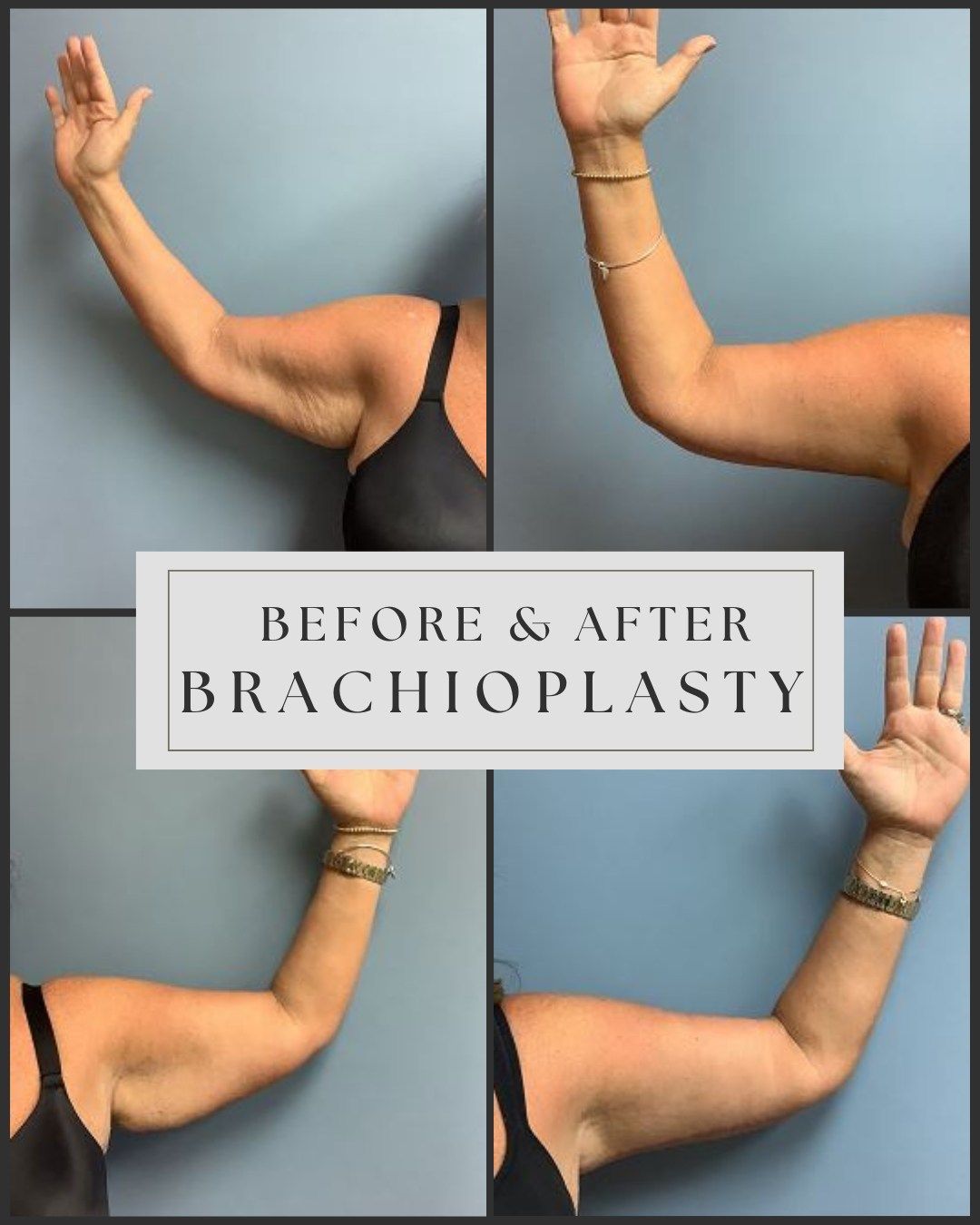 Before & after brachioplasty, showing arm lift. Flabby arms before, smoother arms after surgery.