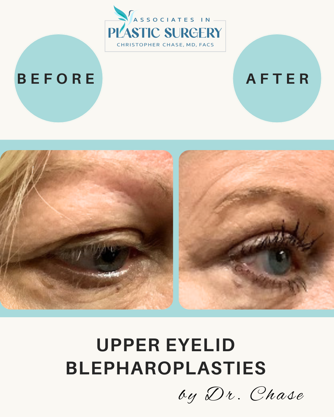 Before and after photos showing an upper eyelid blepharoplasty. The 