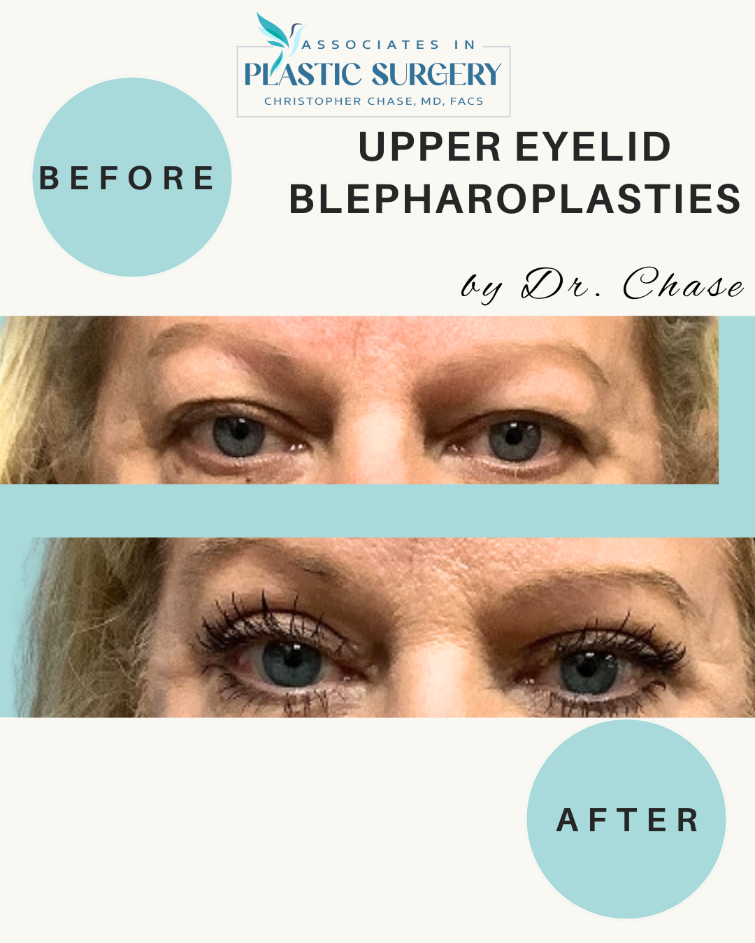 Before and after of upper eyelid blepharoplasty surgery by Dr. Chase, showing eye lift results.