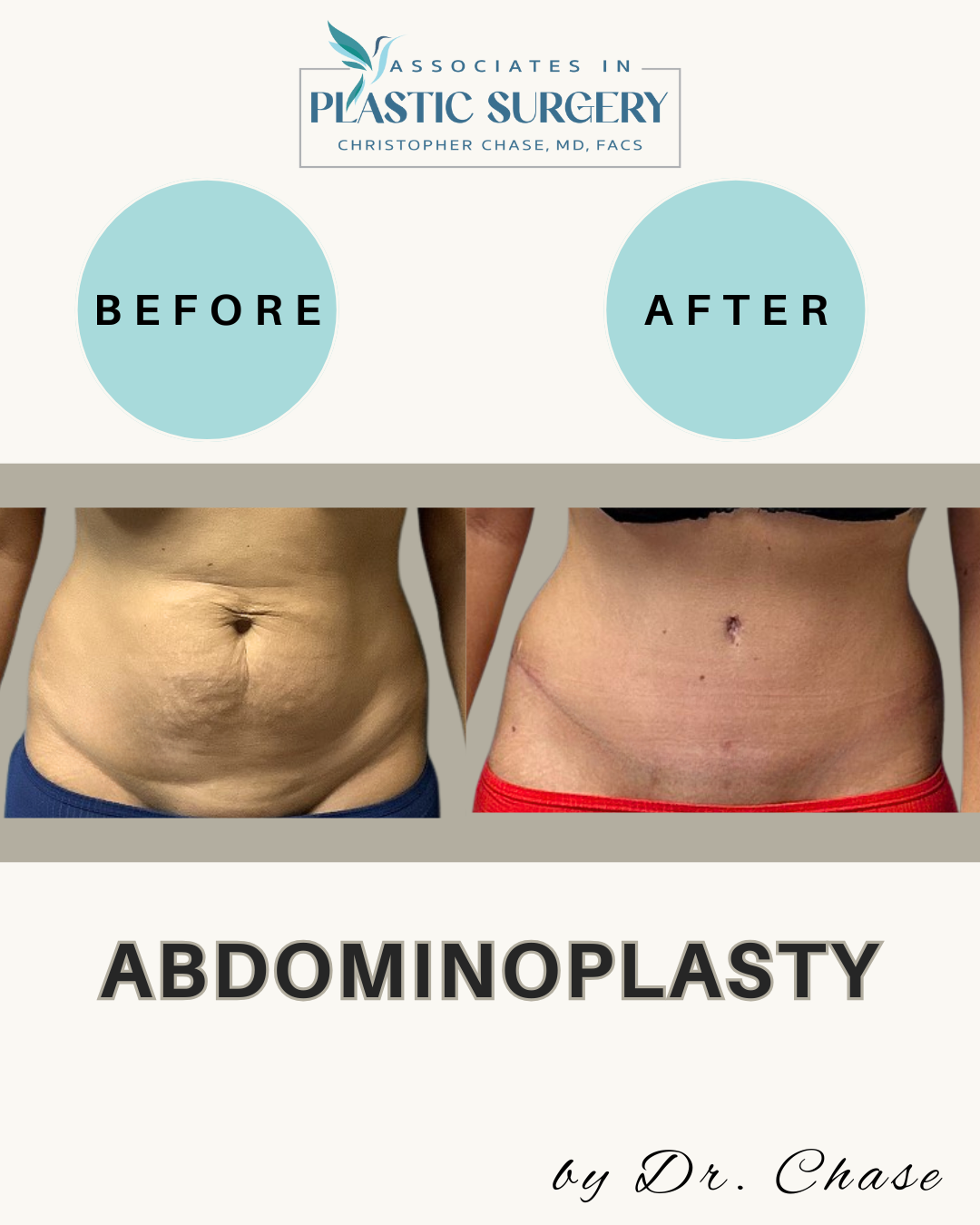 Before and after abdominoplasty photos. Before photo shows wrinkled abdomen. After photo reveals a smoother abdomen.