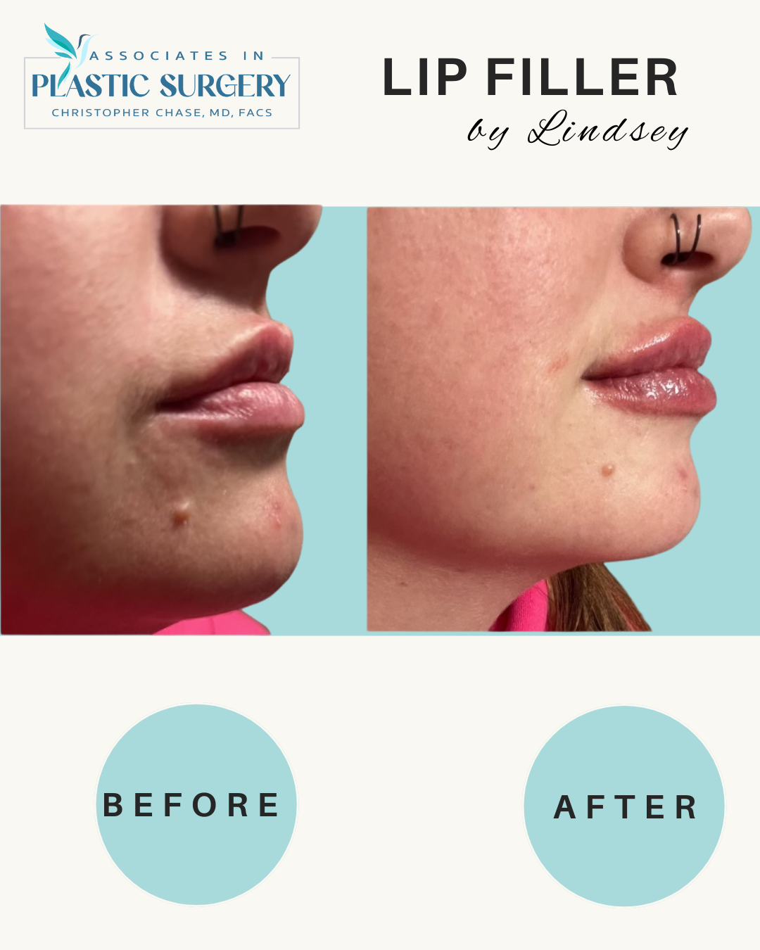 Before and after lip filler treatment; enlarged lips.