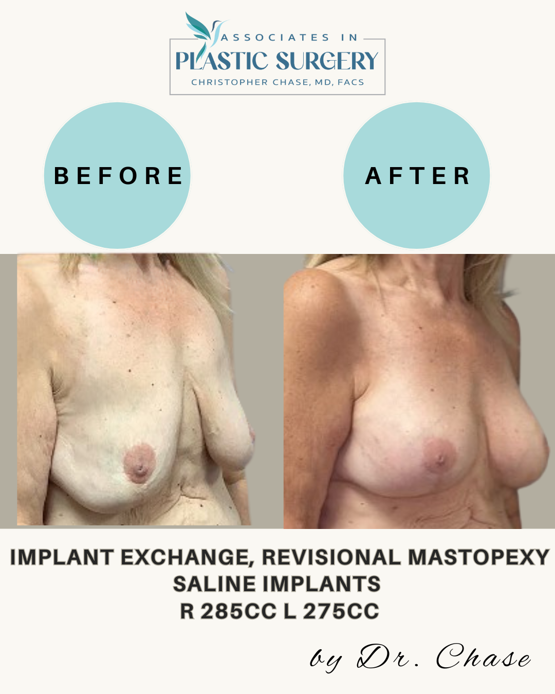 Breast augmentation before and after photos. Shows saline implants, with text.