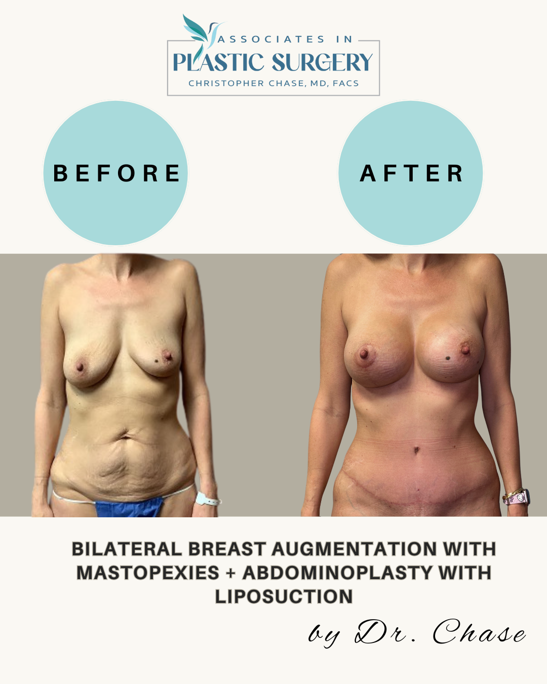 Before and after photos showing results of breast augmentation, mastopexy, abdominoplasty, and liposuction.