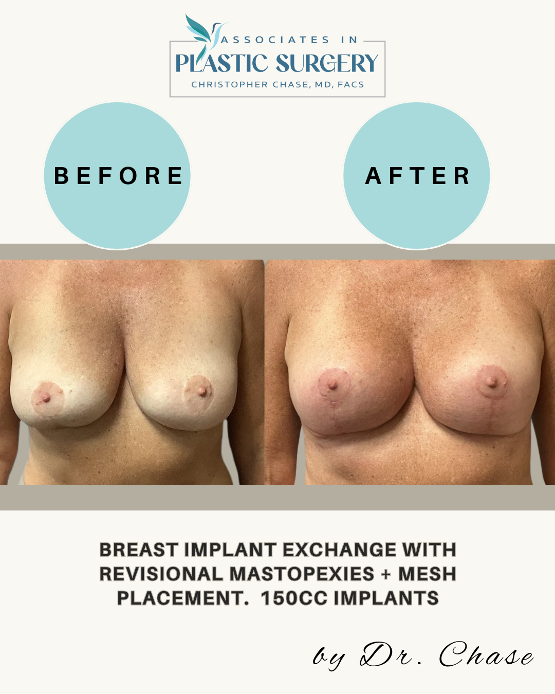 Before and after photos of breast augmentation. Shows breast implant exchange and mastopexy with 150cc implants.
