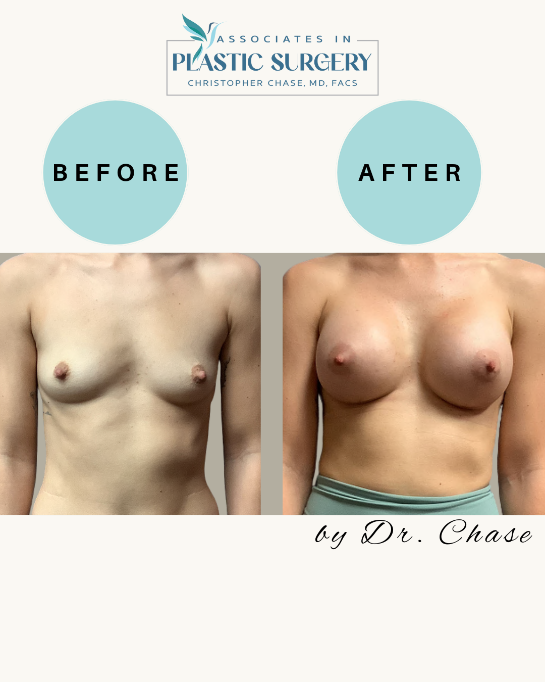 Before and after breast augmentation.  The 