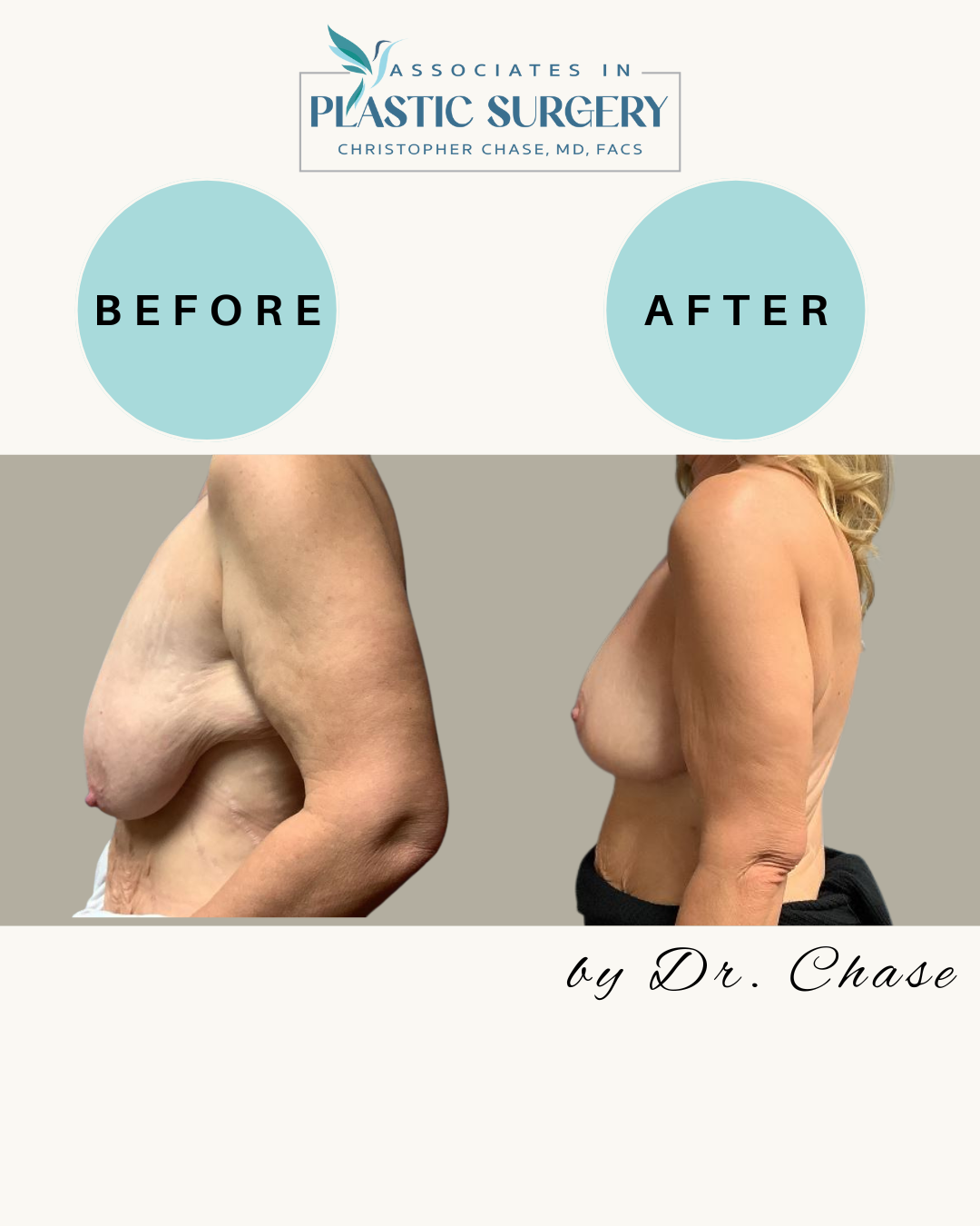 Before and after photos of breast augmentation. Left: sagging breast. Right: lifted and enhanced breast.